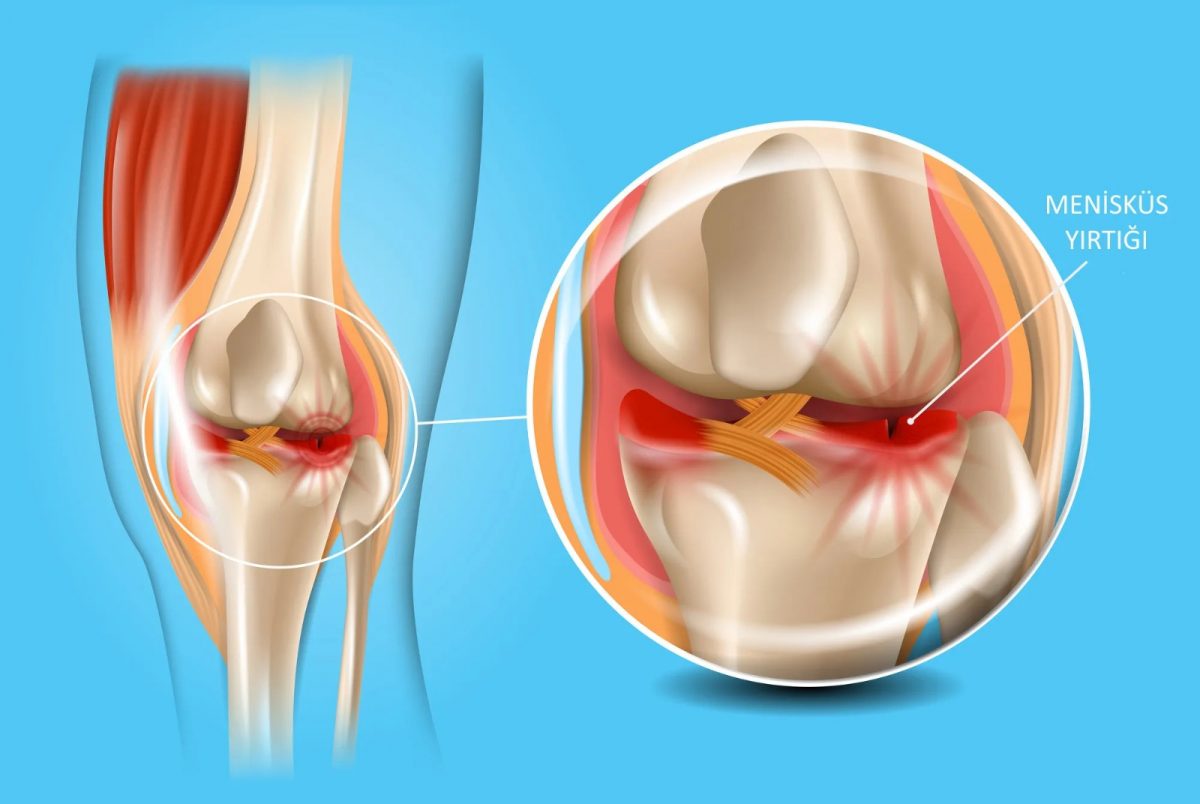 Menisküs Yırtığı Ameliyatı Nedir? Tedavisi Nasıldır?