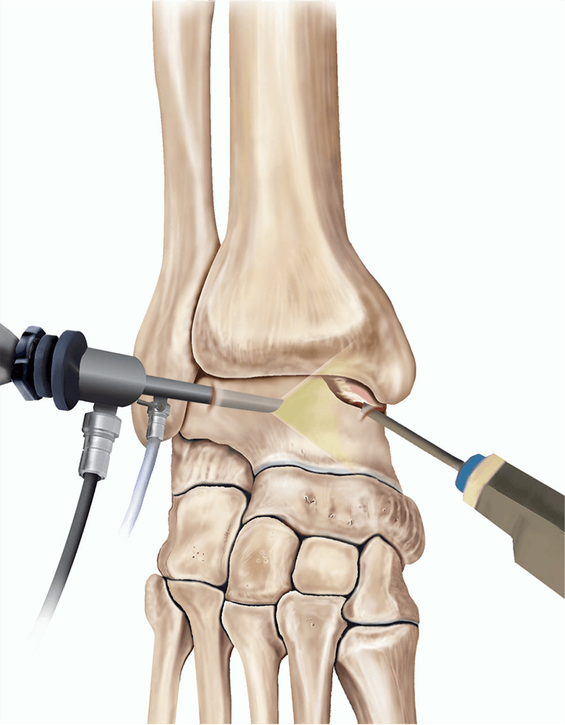 Ayak Bileği Artroskopisi
