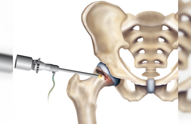 Kalça Kırığı Ameliyatı