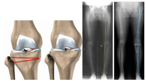 Yüksek Tibial Osteotomi (YTO) Ameliyatı